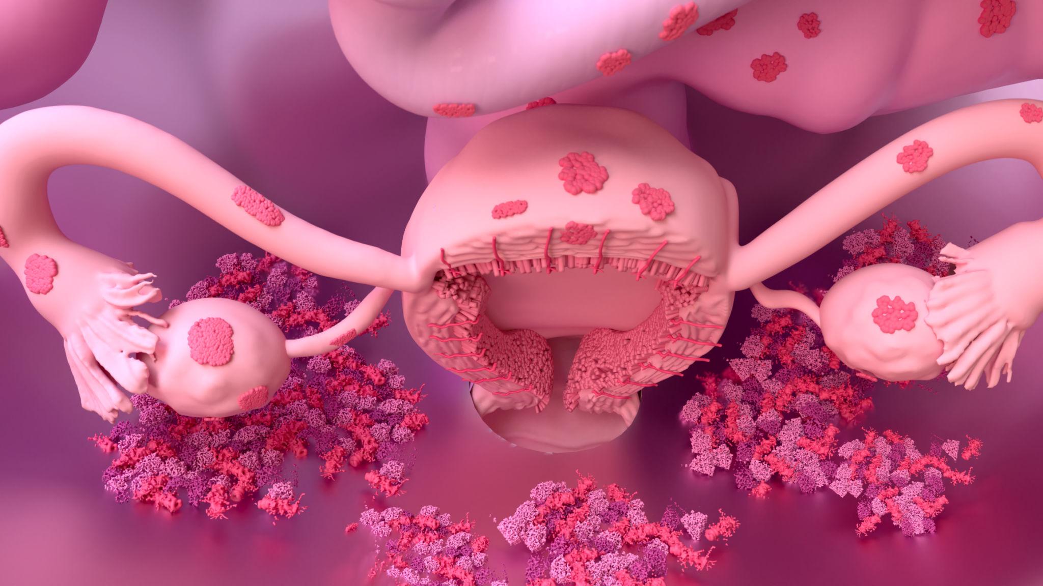 Best Endometriosis Specialist in Hyderabad