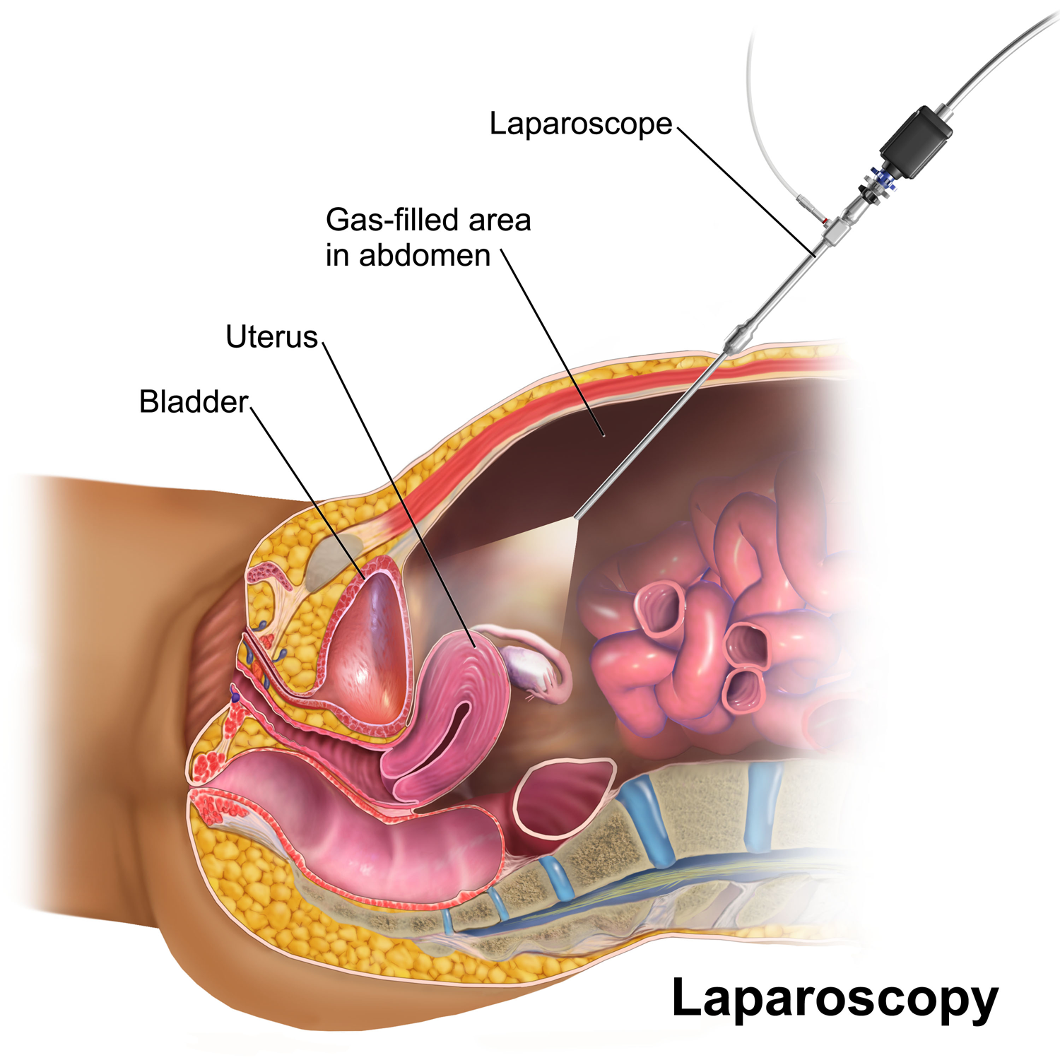 Laparoscopy Cost in Hyderabad